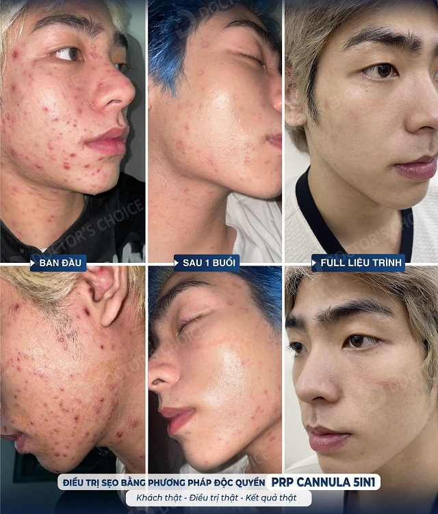 Phòng khám điều trị sẹo rỗ, sẹo lõi nhanh, an toàn tại TPHCM 30 tri seo ro seo lom 11