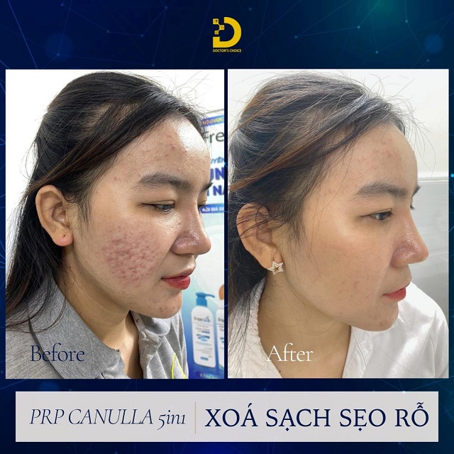 Phòng khám điều trị sẹo rỗ, sẹo lõi nhanh, an toàn tại TPHCM 32 tri seo ro seo lom 13