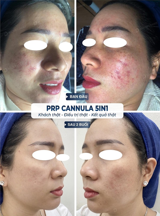 Phòng khám điều trị sẹo rỗ, sẹo lõi nhanh, an toàn tại TPHCM 33 tri seo ro seo lom 14