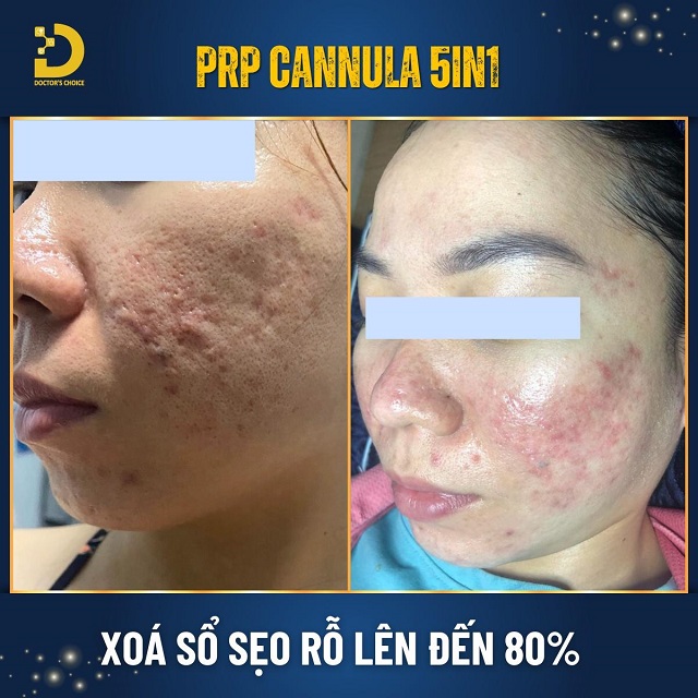 Phòng khám điều trị sẹo rỗ, sẹo lõi nhanh, an toàn tại TPHCM 34 tri seo ro seo lom 15