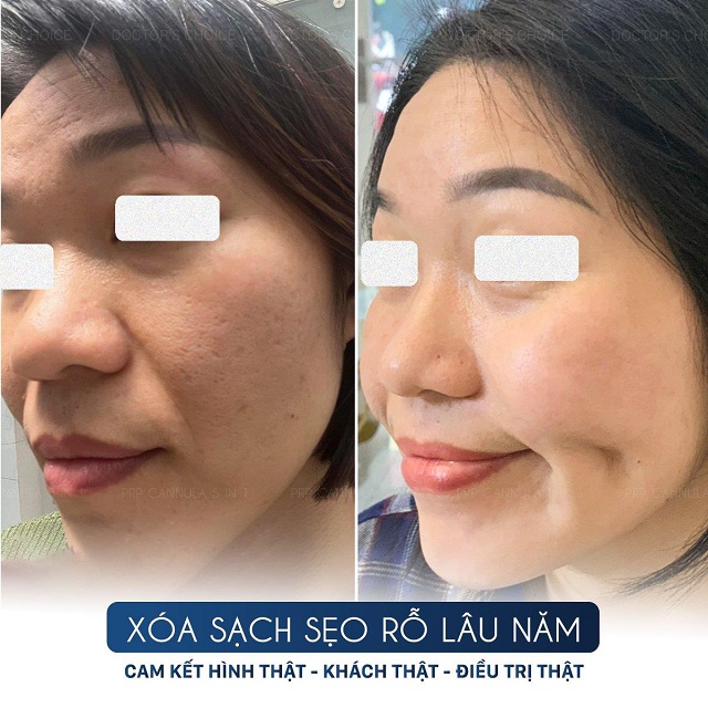 Phòng khám điều trị sẹo rỗ, sẹo lõi nhanh, an toàn tại TPHCM 35 tri seo ro seo lom 16