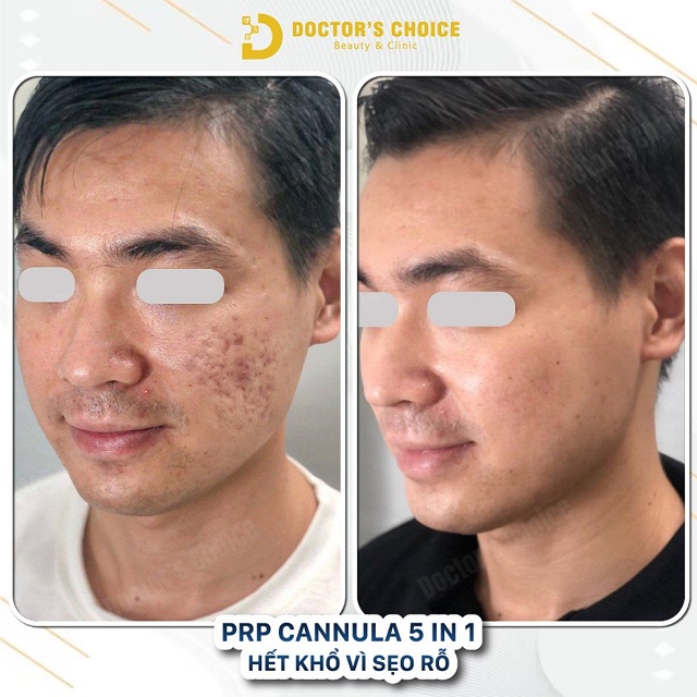Phòng khám điều trị sẹo rỗ, sẹo lõi nhanh, an toàn tại TPHCM 36 tri seo ro seo lom 17