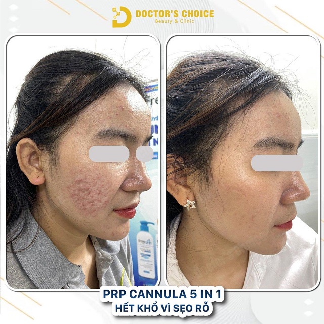 Phòng khám điều trị sẹo rỗ, sẹo lõi nhanh, an toàn tại TPHCM 37 tri seo ro seo lom 18
