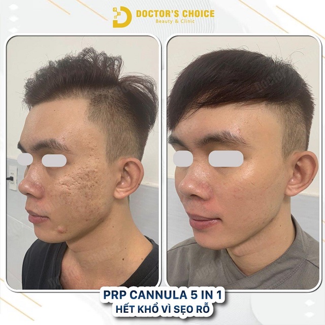 Phòng khám điều trị sẹo rỗ, sẹo lõi nhanh, an toàn tại TPHCM 38 tri seo ro seo lom 19