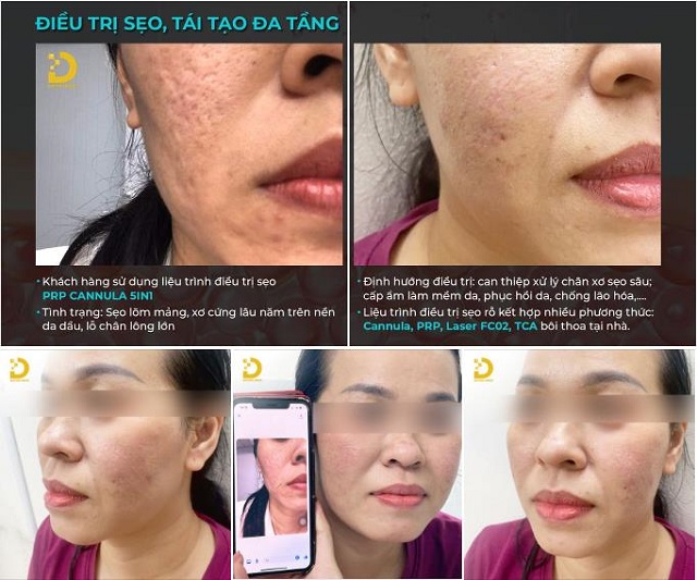 Phòng khám điều trị sẹo rỗ, sẹo lõi nhanh, an toàn tại TPHCM 39 tri seo ro seo lom 20