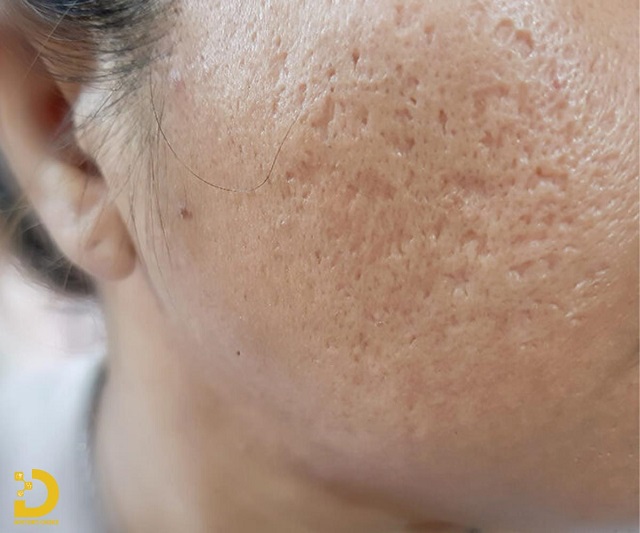 Phòng khám điều trị sẹo rỗ, sẹo lõi nhanh, an toàn tại TPHCM 23 Sẹo rỗ chân vuông