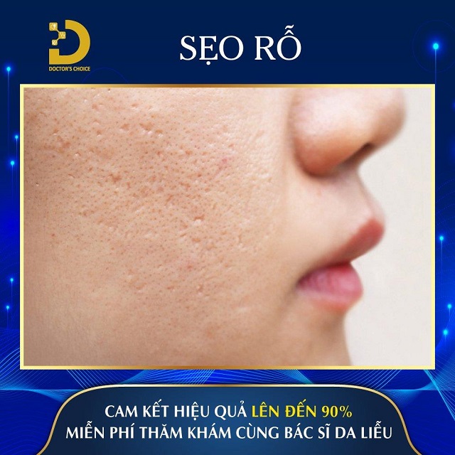 Phòng khám điều trị sẹo rỗ, sẹo lõi nhanh, an toàn tại TPHCM 27 Ảnh điều trị sẹo rỗ tại Dr. Choicer