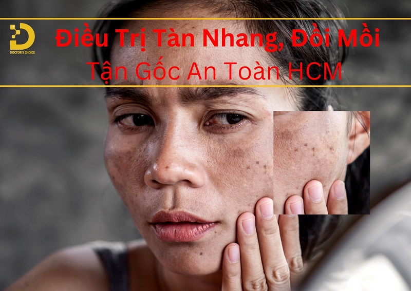 Phòng Khám Điều Trị Tàn Nhang, Đồi Mồi Ở HCM Uy Tín 8 Điều trị tàn nhanh, đồi mồi tận gốc tại HCM