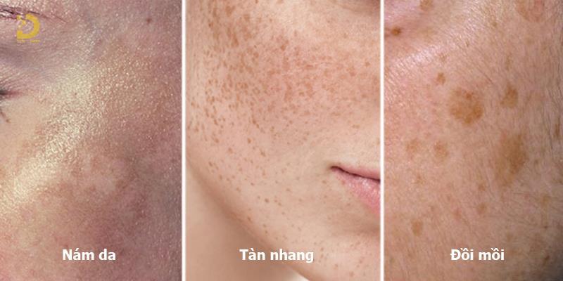 Phòng Khám Điều Trị Tàn Nhang, Đồi Mồi Ở HCM Uy Tín 9 tri tan nhang doi moi 2