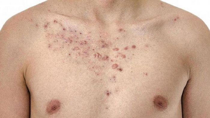 Phòng khám điều trị thâm ngực đẹp, an toàn tại TPHCM 7 Mụn, viêm nang lông ở ngực có thể gây ra tình trạng thâm ngực