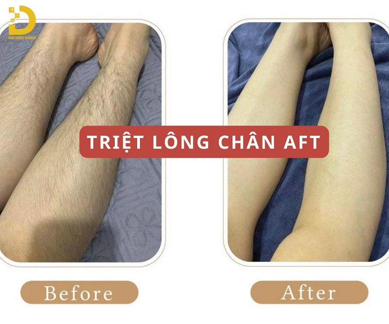 Dịch Vụ Triệt Lông Chân Nam, Nữ An Toàn, Giá Tận Gốc Tại TPHCM 10 triet long chan 4