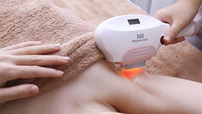 Dịch vụ triệt lông nách "vĩnh viễn" tại TPHCM hiệu quả không đau 12 Triệt lông nách công nghệ ánh sáng IPL
