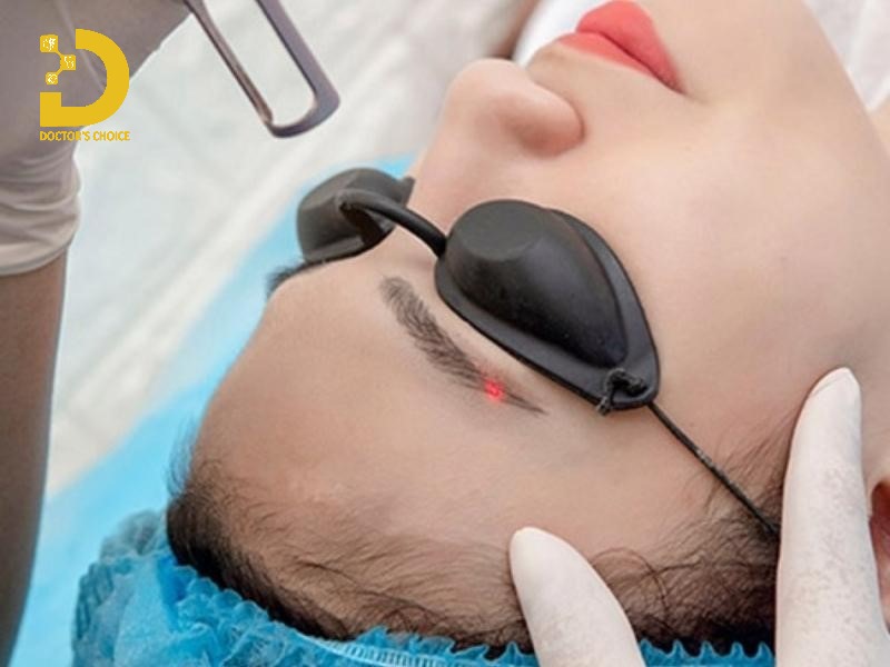 Dịch Vụ Triệt Lông Mày Ở HCM An Toàn, Hiệu Quả 15 Thời gian thực hiện triệt lông mày bằng Laser Diode, SHR chỉ khoảng 15-30 phút