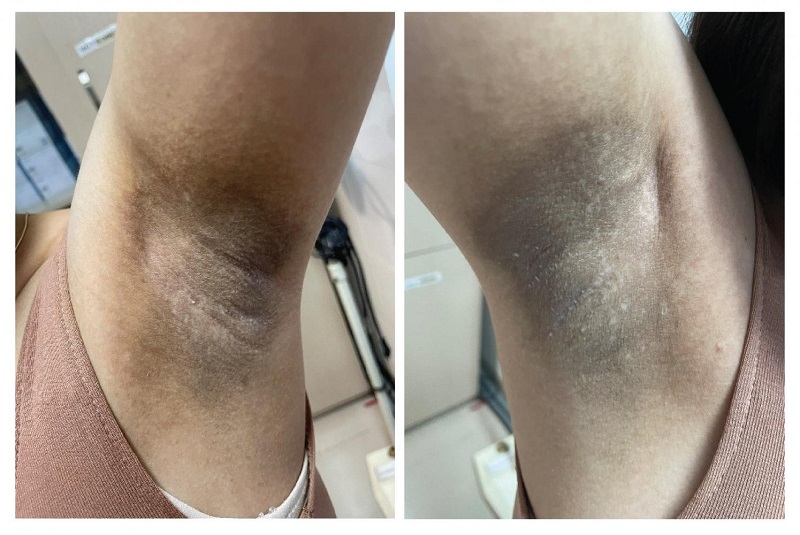 Dịch vụ triệt lông nách "vĩnh viễn" tại TPHCM hiệu quả không đau 10 Triệt lông nách sai cách gây thâm sạm, sẹo, rối loạn sắc tố da