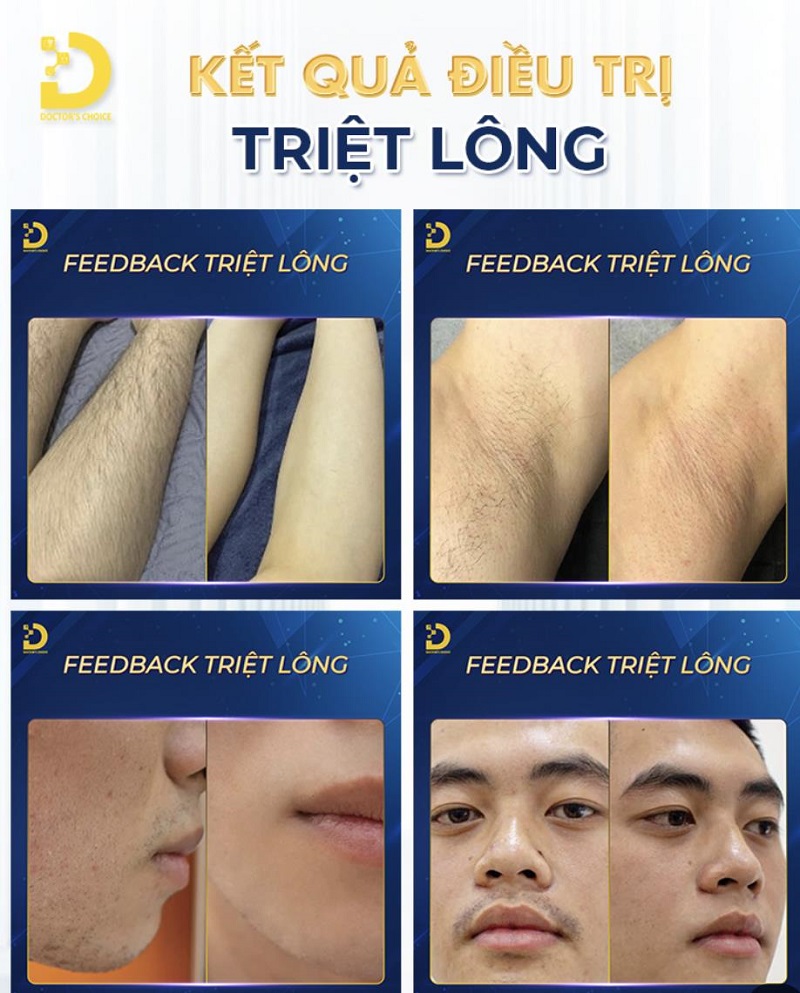 Dịch Vụ Triệt Lông Toàn Thân Vĩnh Viễn, An Toàn Tại TPHCM 13 triet long toan than 6