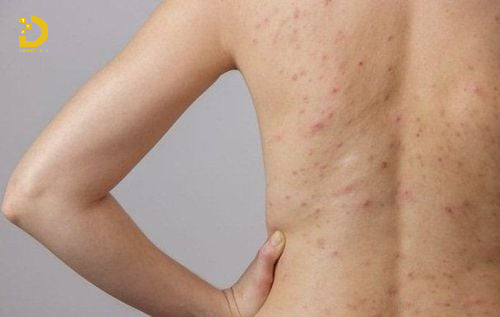 Phòng Khám Điều Trị Viêm Nang Lông Hiệu Quả, An Toàn Tại TPHCM 10 Viêm nang lông nông