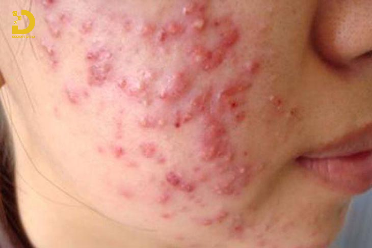 Phòng Khám Điều Trị Viêm Nang Lông Hiệu Quả, An Toàn Tại TPHCM 11 Viêm nang lông sâu