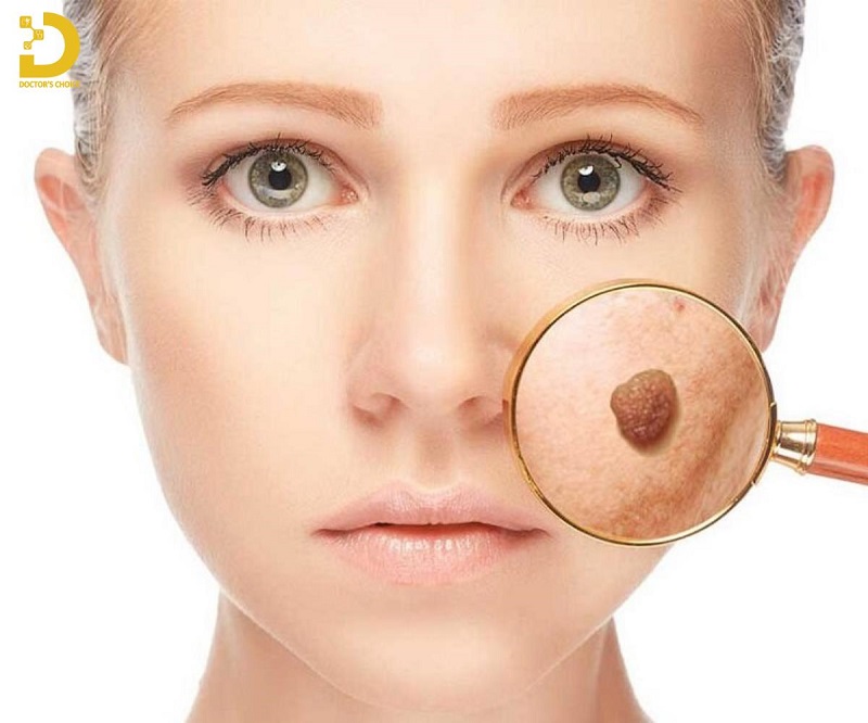 Dịch Vụ Xóa Nốt Ruồi Thẩm Mỹ Uy Tín, An Toàn TPHCM 7 xoa not ruoi tham my 2