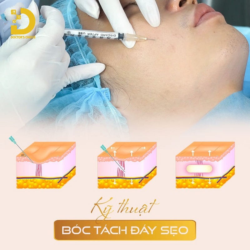 Sẹo Giãn Là Gì? Cách Phòng Ngừa Và Điều Trị Hiệu Quả 15 Điều trị sẹo giãn ằng cách cắt đáy sẹo Cannula