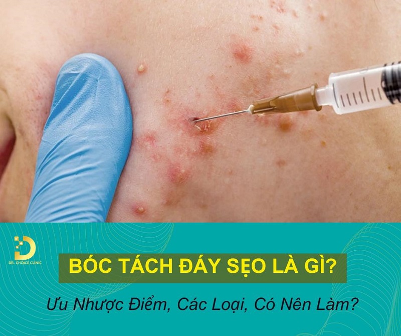 Bóc Tách Đáy Sẹo Là Gì? Ưu Nhược Điểm, Các Loại, Có Nên Làm? 9 Bóc tách đáy sẹo là gì