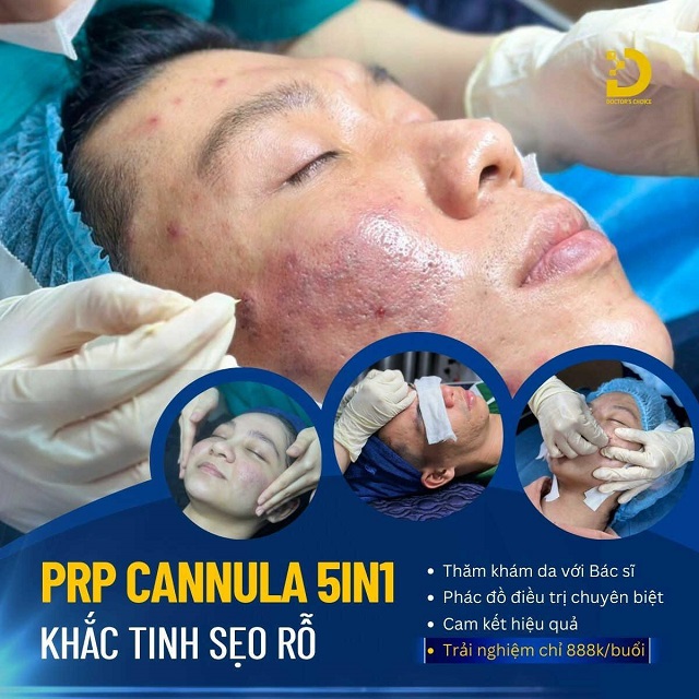 Bóc Tách Đáy Sẹo Là Gì? Ưu Nhược Điểm, Các Loại, Có Nên Làm? 12 Bóc tách đáy sẹo bằng ống Cannula