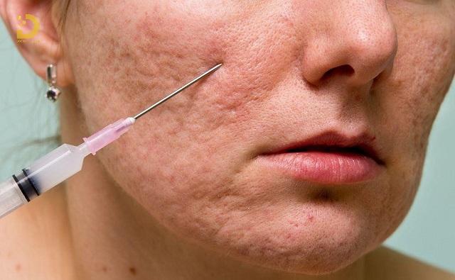 Bóc Tách Đáy Sẹo Là Gì? Ưu Nhược Điểm, Các Loại, Có Nên Làm? 13 Tách đáy sẹo kim 23G