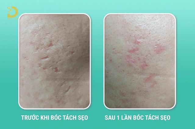 Bóc Tách Đáy Sẹo Là Gì? Ưu Nhược Điểm, Các Loại, Có Nên Làm? 14 boc tach day seo 6