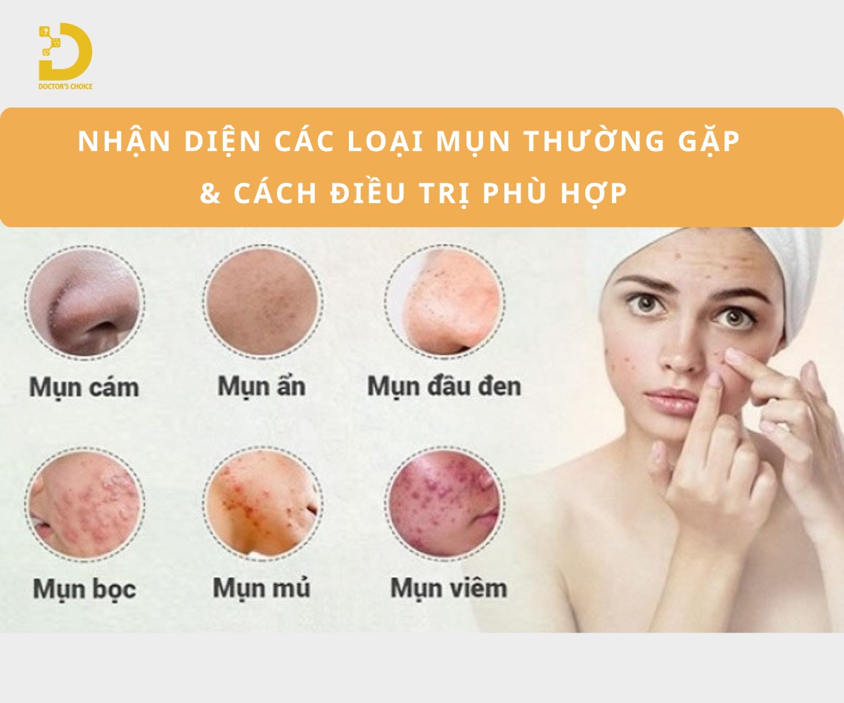 Các Loại Mụn Thường Gặp: Cách Phân Biệt & Điều Trị Phù Hợp 21 Các loại mụn thường gặp và cách điều trị phù hợp