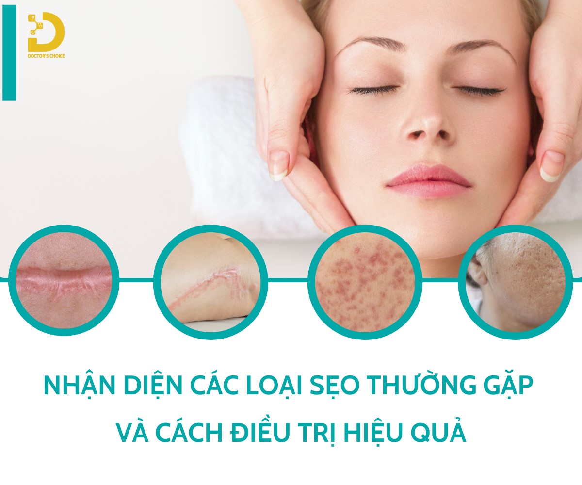 Nhận Diện Các Loại Sẹo Thường Gặp Và Cách Điều Trị Hiệu Quả 16 Các loại sẹo thường gặp và cách điều trị phù hợp