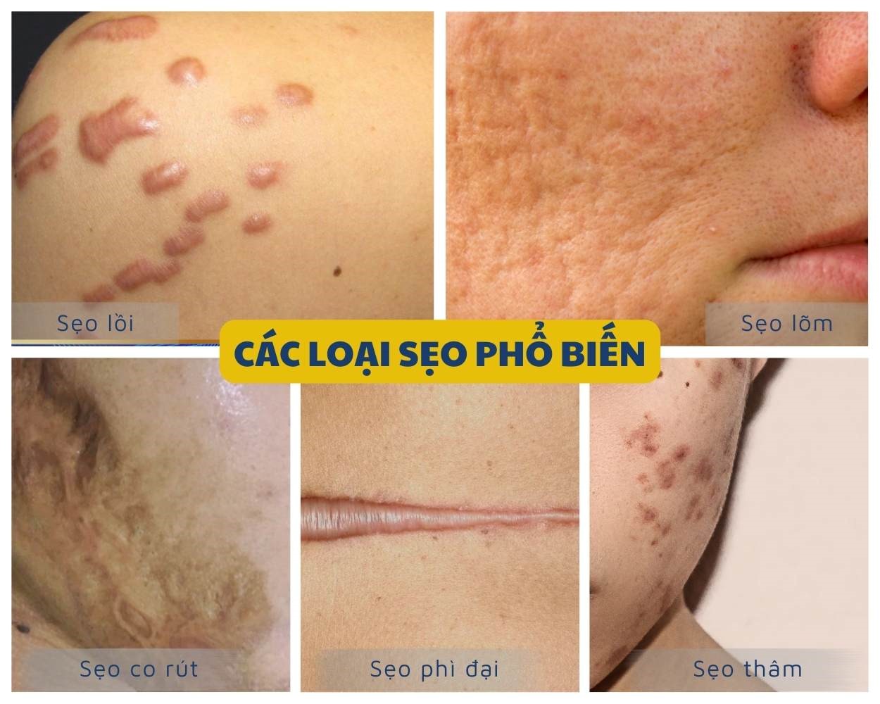 Chi Phí Điều Trị Sẹo Phụ Thuộc Vào Yếu Tố Nào? Bảng Giá Tham Khảo 10 Các loại sẹo phổ biến hiện nay