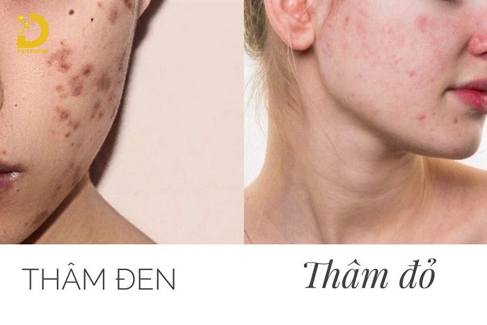 Thâm Mụn Có Tự Hết Không? Cách Phòng Ngừa Và Điều Trị Hiệu Quả 13 Các loại thâm mụn phổ biến