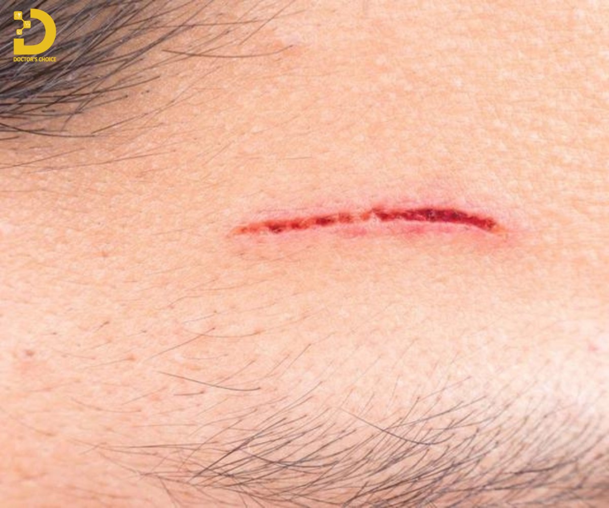 Cách Trị Vết Thương Không Để Lại Sẹo Hiệu Quả 11 Các yếu tố ảnh hưởng quá trình lành vết thương