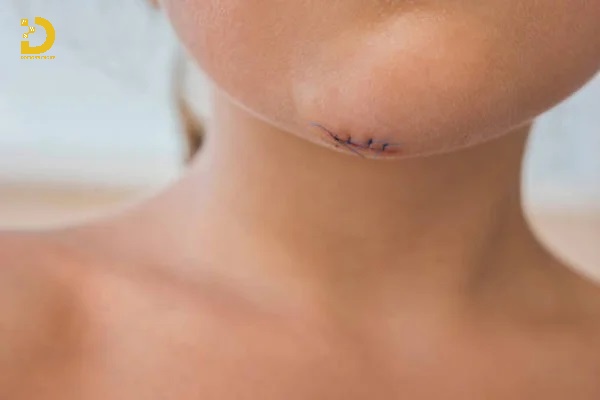 Cách Trị Vết Thương Không Để Lại Sẹo Hiệu Quả 17 Theo giỏi vết thương trong quá trình tái tạo