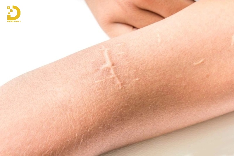 Cách Trị Vết Thương Không Để Lại Sẹo Hiệu Quả 12 Các yếu tố cơ địa gồm có tuổi tác, tình trạng sức khoẻ ảnh hưởng quá trình lành vết thương