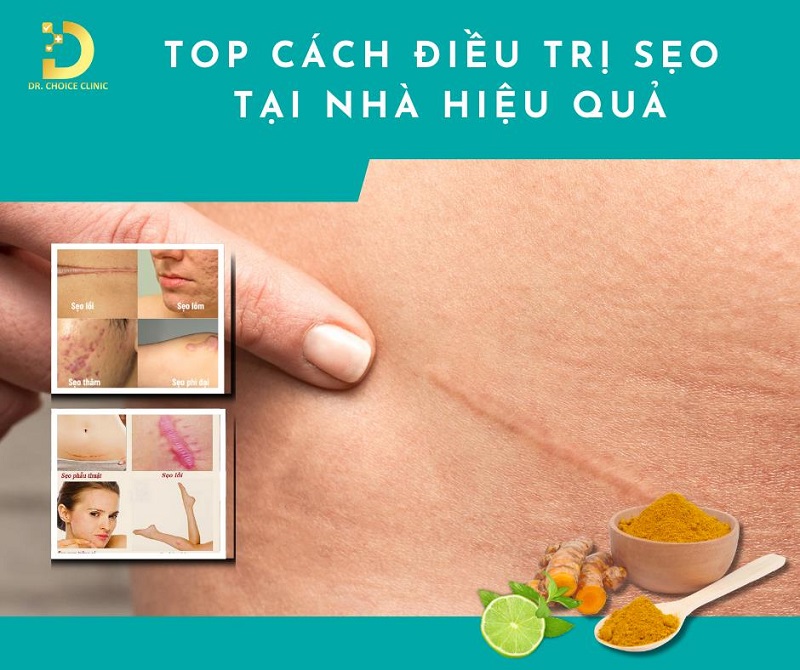 Top 7+ Cách Điều Trị Sẹo Tại Nhà An Toàn, Hiệu Quả 11 cách điều trị sẹo tại nhà