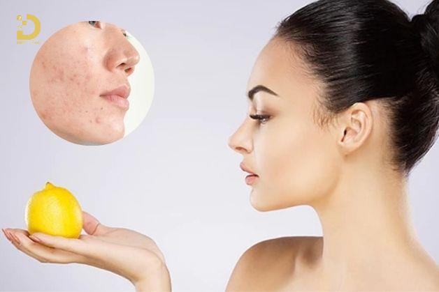 Top 7+ Cách Điều Trị Sẹo Tại Nhà An Toàn, Hiệu Quả 12 Trị sẹo bằng chanh