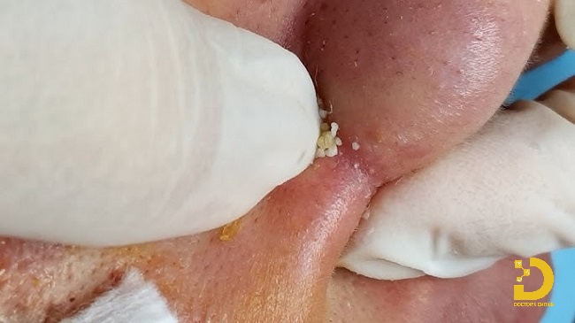 Mụn Cám: Nguyên Nhân, Cách Nặn Mụn & Điều Trị Hiệu Quả 12 Có nên nặn mụn cám không