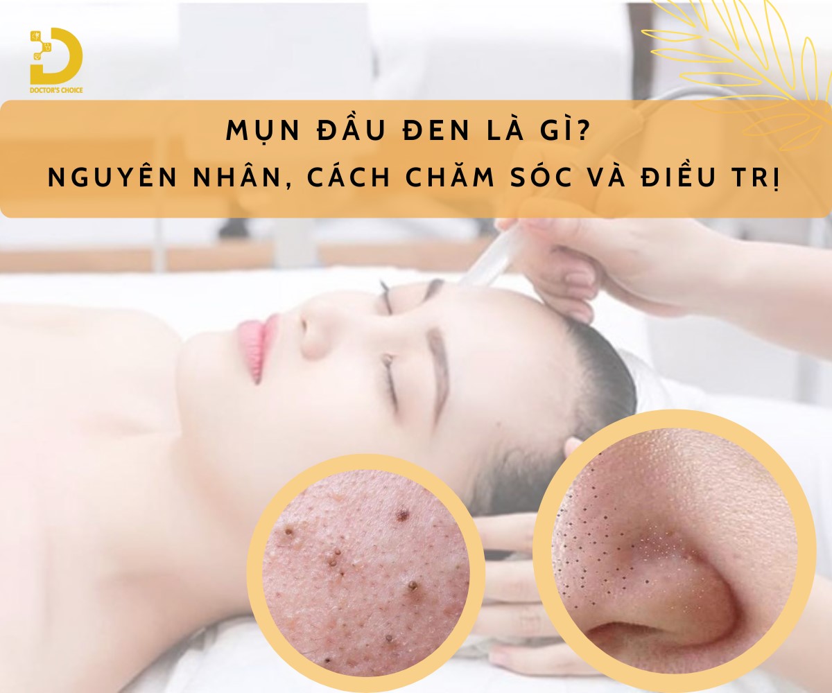 Mụn Đầu Đen Là Gì? Nguyên Nhân, Cách Chăm Sóc Và Điều Trị 11 Tìm hiểu về mụn đầu đen và cách điều trị hiệu quả