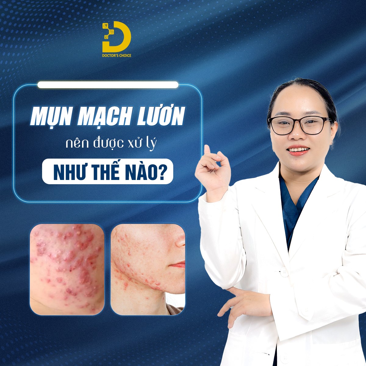 Mụn Mạch Lươn: Nguyên Nhân Và Cách Điều Trị Chuẩn Y Khoa 9 Các phương pháp điều trị mụn mạch lươn hiệu quả