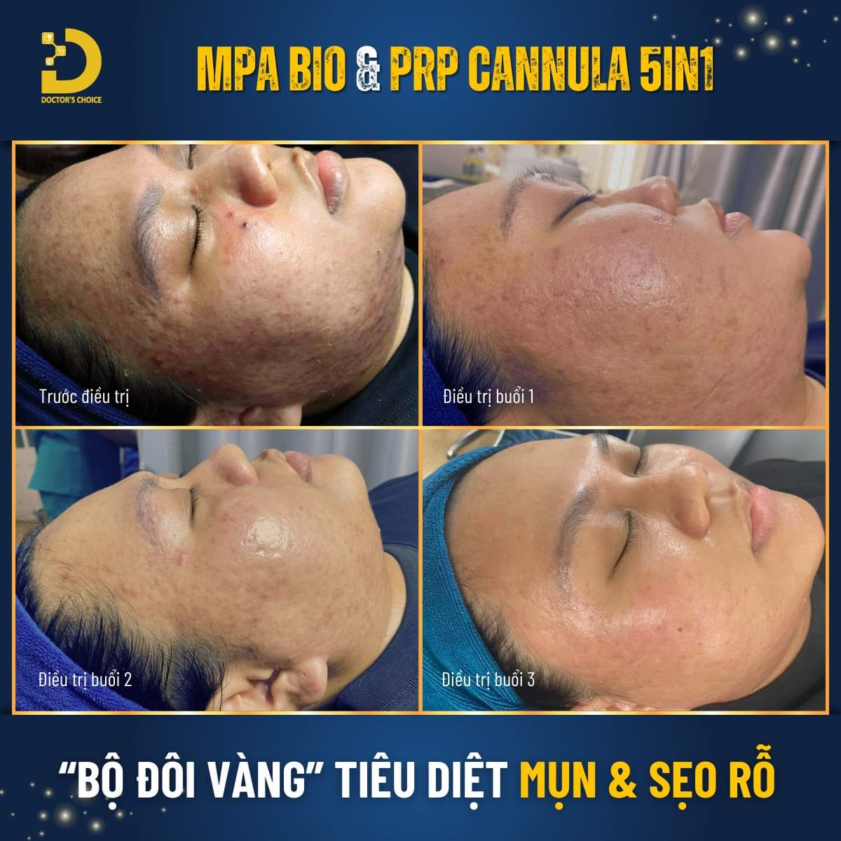 Chi Phí Điều Trị Sẹo Phụ Thuộc Vào Yếu Tố Nào? Bảng Giá Tham Khảo 12 Kết quả trị mụn và sẹo rỗ bằng công nghệ MPA BIO kết hợp PRP