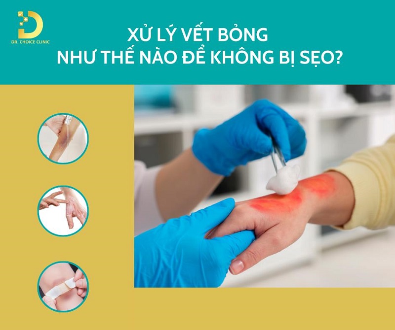 Xử Lý Vết Bỏng Như Thế Nào Để Không Bị Sẹo? 8 cách xử lý vết bỏng không để lại sẹo