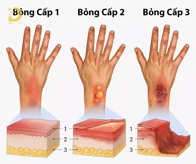 Xử Lý Vết Bỏng Như Thế Nào Để Không Bị Sẹo? 9 dieu tri seo bong 2
