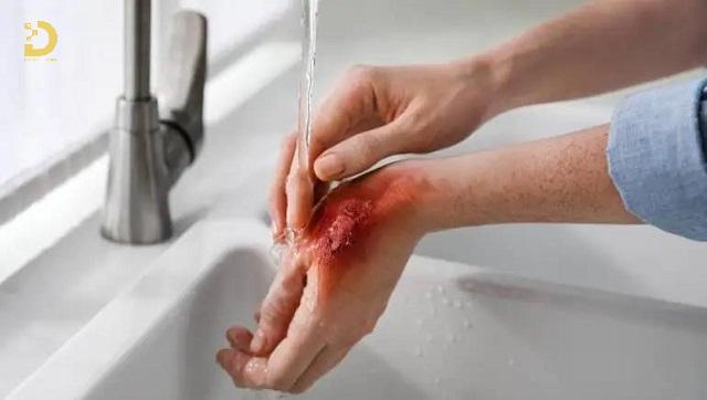 Xử Lý Vết Bỏng Như Thế Nào Để Không Bị Sẹo? 10 dieu tri seo bong 3