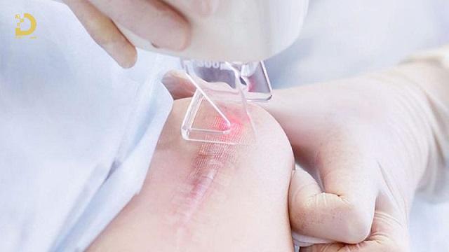 Cách Ngừa Sẹo Khi Bị Thủy Đậu, Zona Hiệu Quả 8 dieu tri seo bong 6