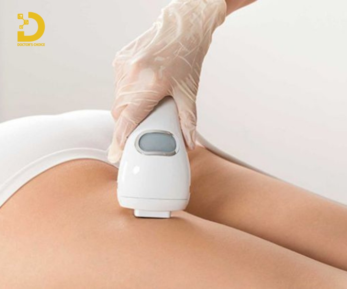 Sẹo Giãn Là Gì? Cách Phòng Ngừa Và Điều Trị Hiệu Quả 14 Điều trị sẹo giãn bằng laser