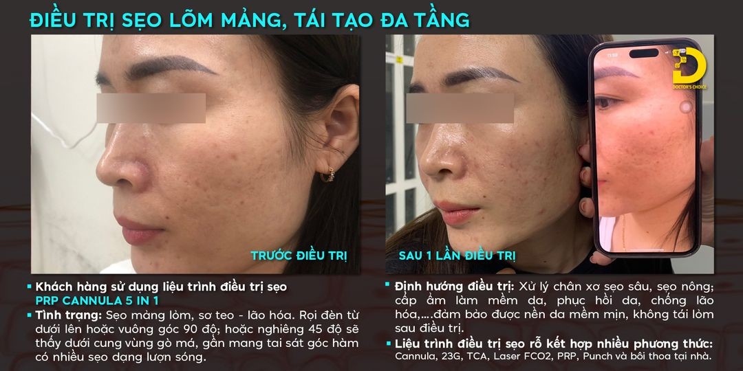 Nhận Diện Các Loại Sẹo Thường Gặp Và Cách Điều Trị Hiệu Quả 24 Kết quả khách hàng trị sẹo bằng phương pháp PRP