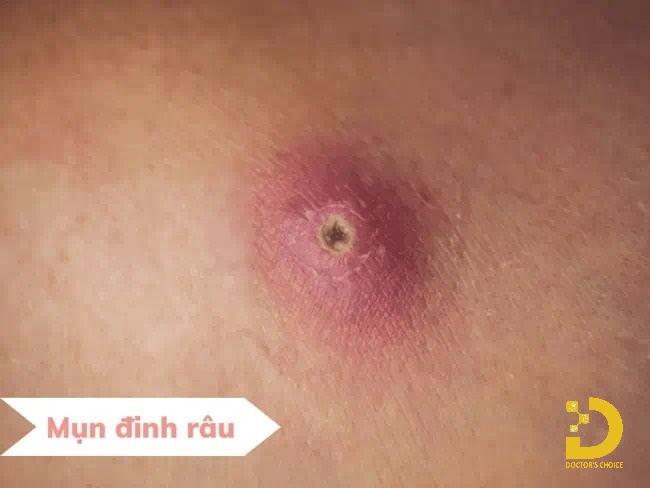 Mụn Đầu Đinh: Nguyên Nhân, Cách Nhận Biết và Điều Trị Hiệu Quả 13 Hình ảnh mụn đầu đinh (mụn đinh râu)