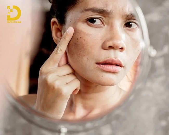 Thâm Da Do Đâu? Các Loại Thâm Da Thường Gặp Và Cách Điều Trị Hiệu Quả 11 Da bị thâm (ảnh minh họa)