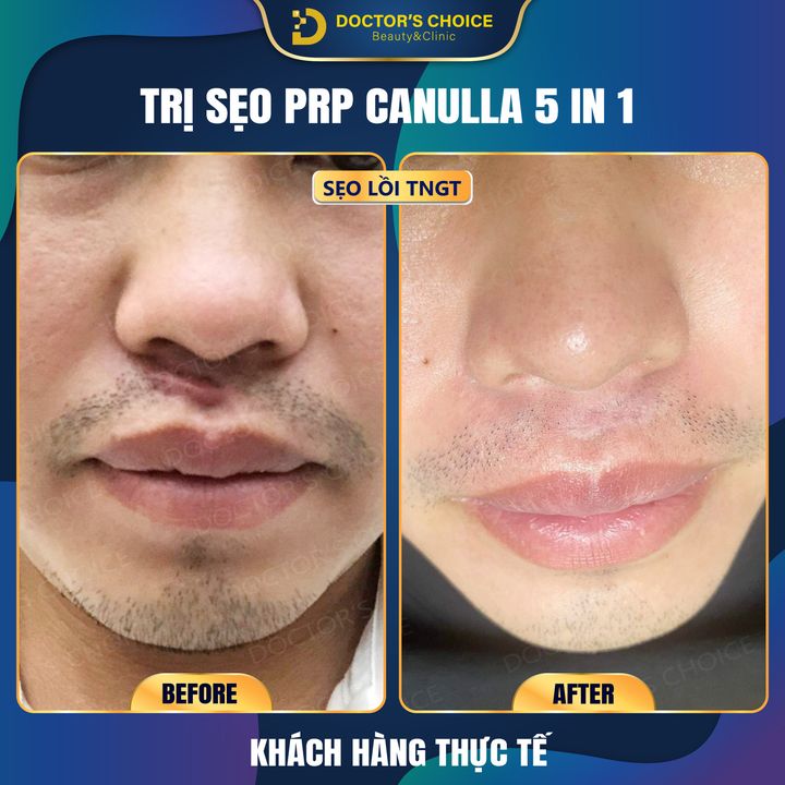 Chi Phí Điều Trị Sẹo Phụ Thuộc Vào Yếu Tố Nào? Bảng Giá Tham Khảo 14 Hình ảnh thực tế trị sẹo bằng công nghệ PRP CANULLA 5 IN 1