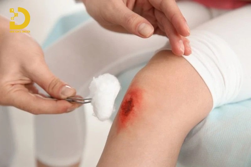 Cách Trị Vết Thương Không Để Lại Sẹo Hiệu Quả 15 Xử lý vết thương không để lại sẹo